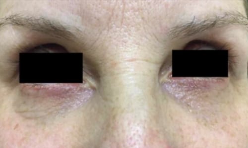 Safe, Effective and Long Lasting Skin Rejuvenation