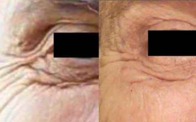 Autologous Platelet Rich Plasma Skin Rejuvenation