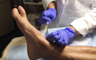 PRP Injections for Ankle Injury