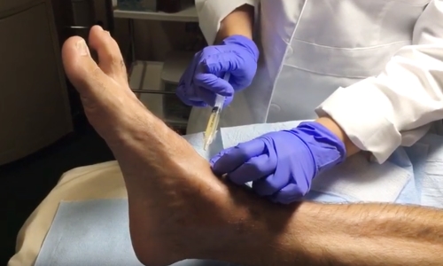 PRP Injections for Ankle Injury