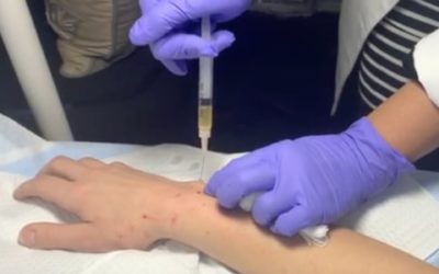 PRP for Wrist Pain